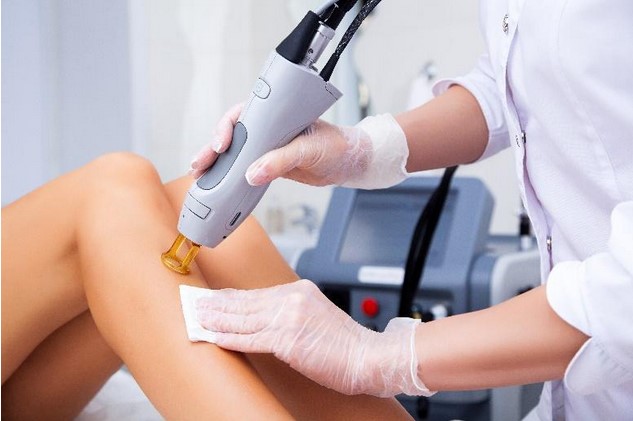 Endovenous Laser Treatment (EVLT) Using a Laser for Varicose Veins